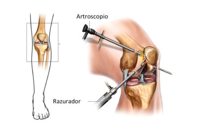 Artroscopia: ¿Qué es? ¿Cuáles son sus beneficios?